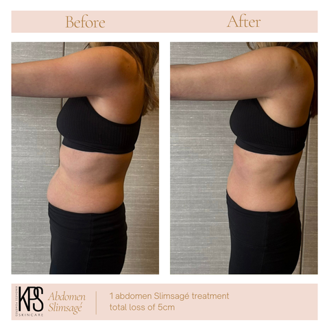 Abdomen Slimsagé – Left