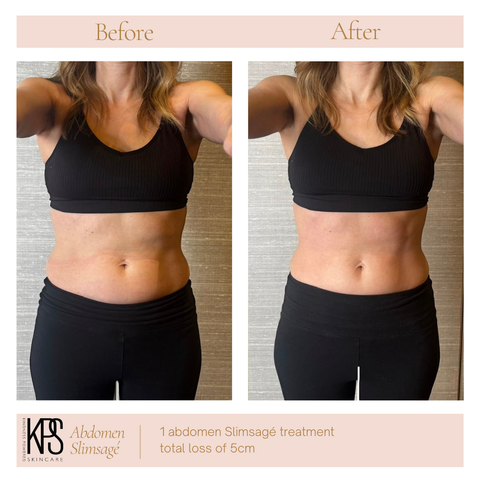 Abdomen Slimsagé – Front