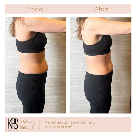 Abdomen Slimsagé – Right