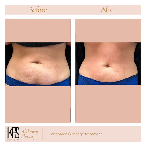 Abdomen Slimsagé Treatment