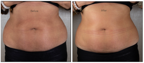Abdomen Slimsagé – total loss of 5cm